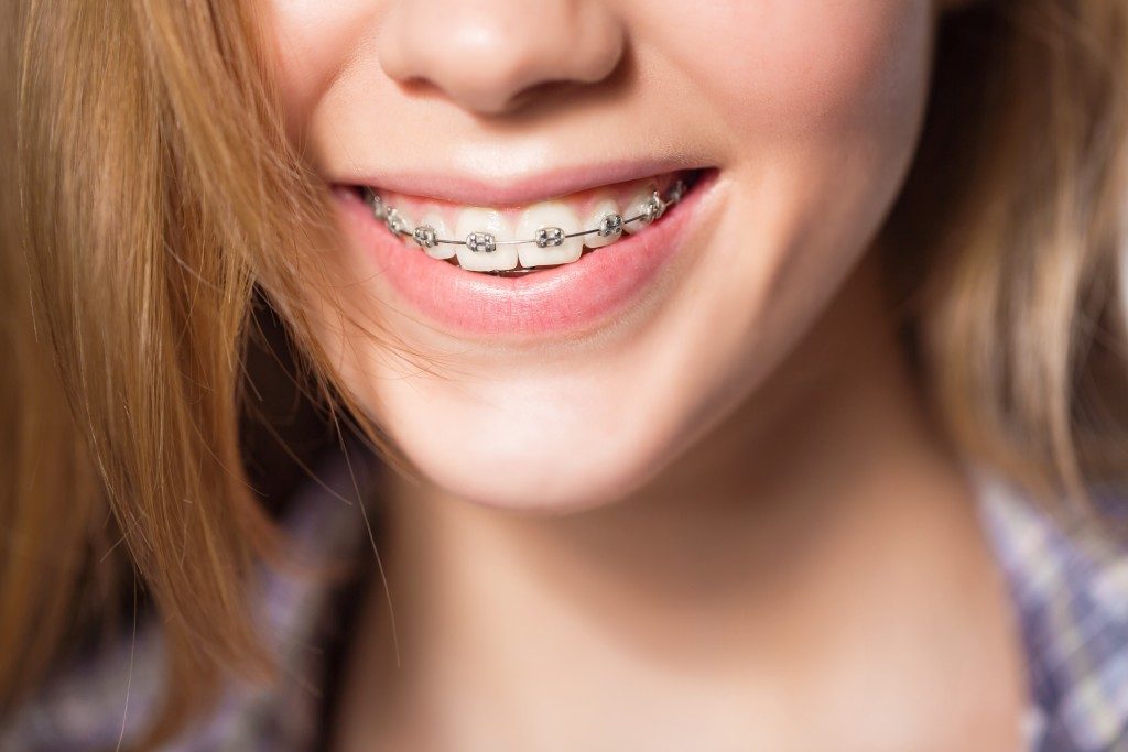 close up shot of a teen weraing braces