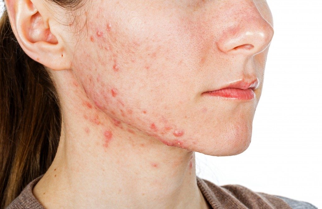 acne on the jaw